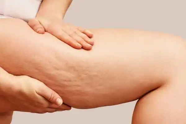 Image of woman showing leg with cellulite Ripley