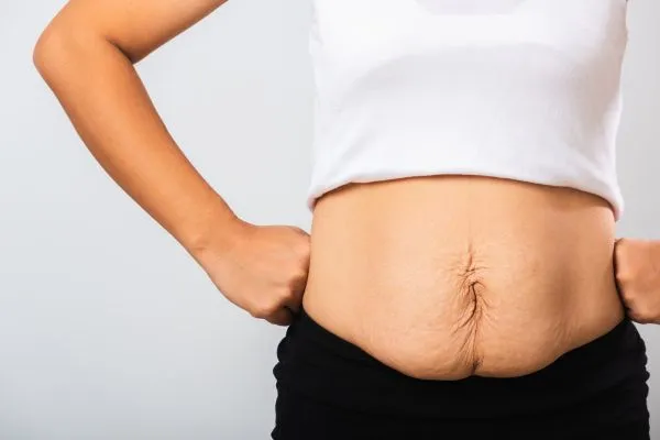 Image of a woman's stomach after weight loss with sagging skin following a gastric band Ripley